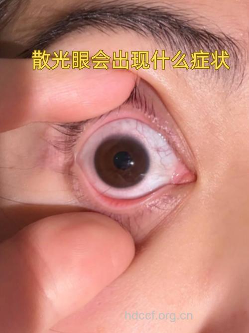 轻微散光有哪些症状
