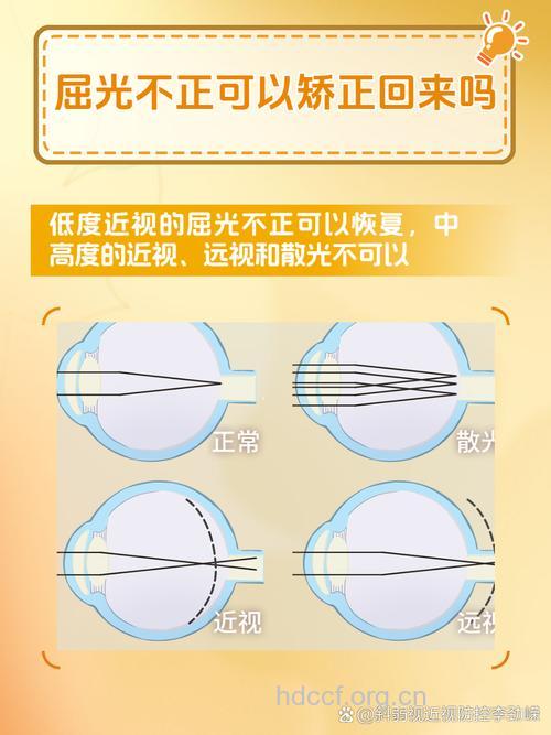 屈光不正的基本治疗有哪些？