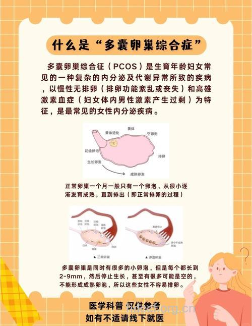多囊卵巢综合征治疗 恢复排卵是关键