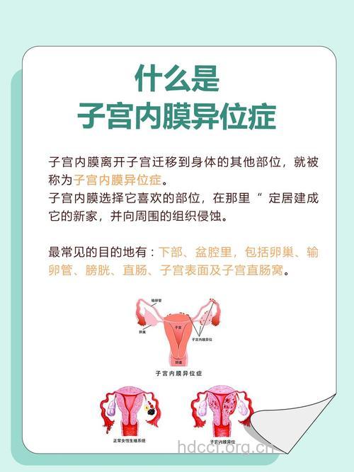 子宫内膜异位症对怀孕有何影响?
