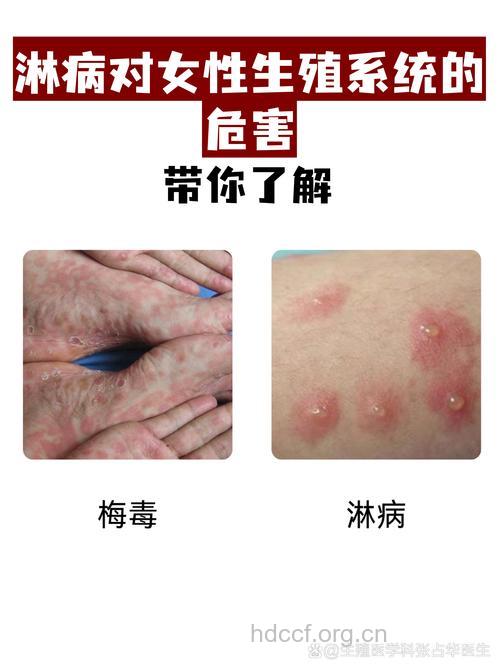 得了淋病,她不敢享受甜蜜性爱!