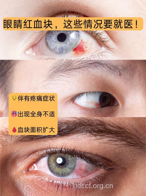 眼睛充血小心“红眼病”