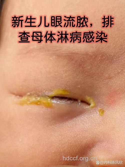 病例分析:新生儿淋病性结膜炎