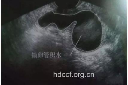慢性输卵管炎的分型