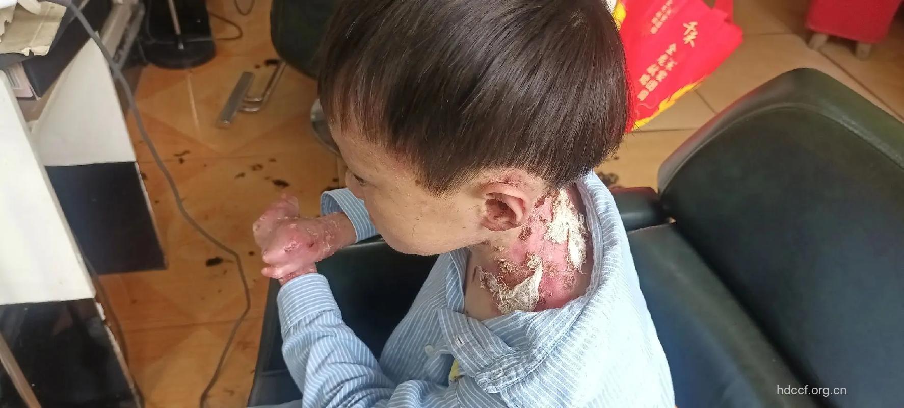 无辜的幼儿竟染上“淋病”