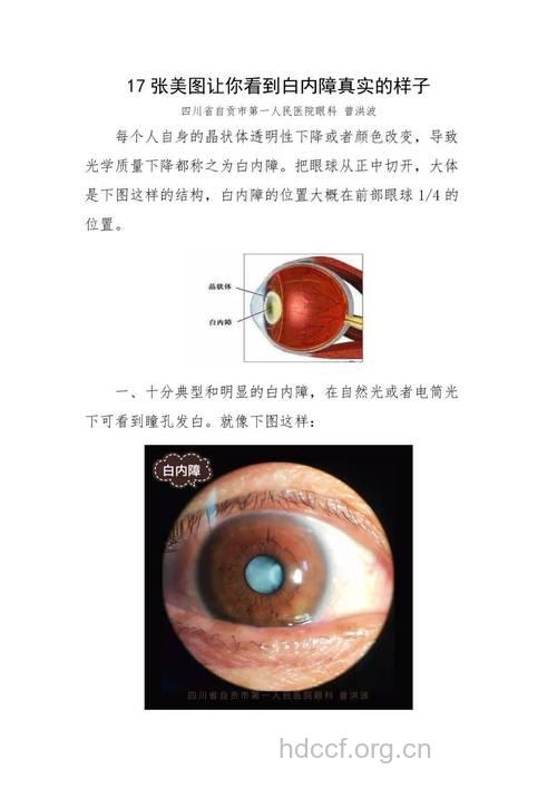 胎儿晶状体异常都会引起白内障
