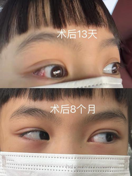 小孩斜视越早做手术越好