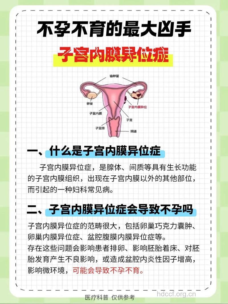 关于子宫内膜异位的4大体征