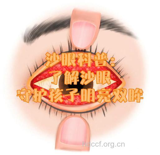 儿童沙眼不容忽视