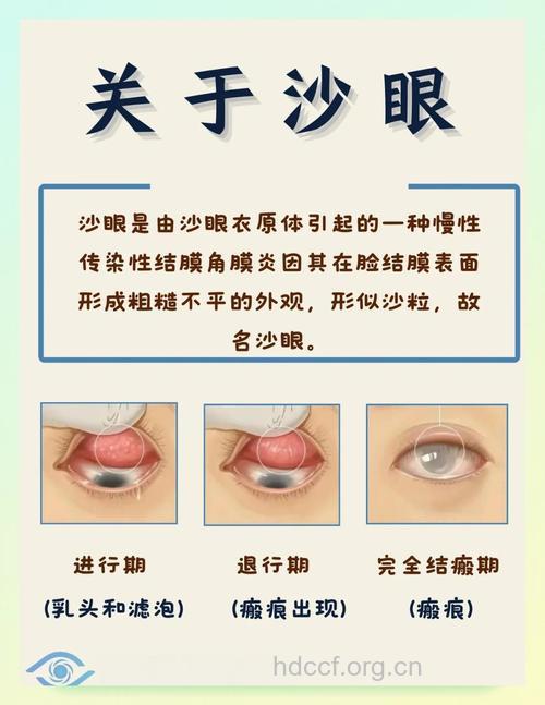 沙眼可导致不孕