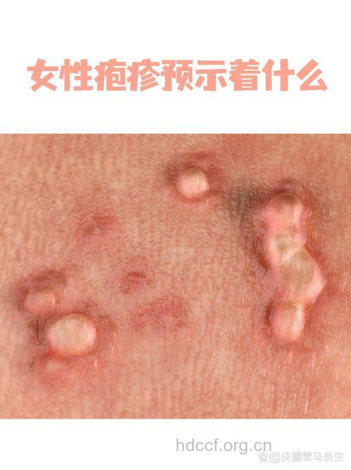 单纯性疱疹的症状和检查