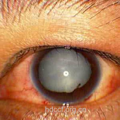 飞行员易得细胞核白内障