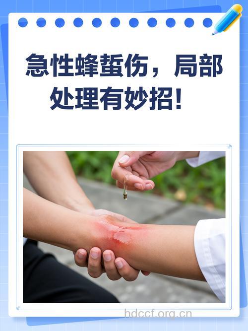 被马蜂蜇伤该如何急救 拔出毒刺清水冲洗