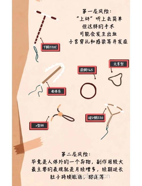 关于避孕环要懂的知识