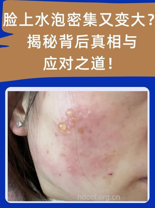 这样洗澡脸上长痘体湿重