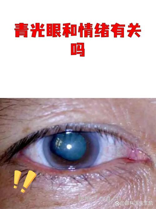 情绪波动大也可引发青光眼