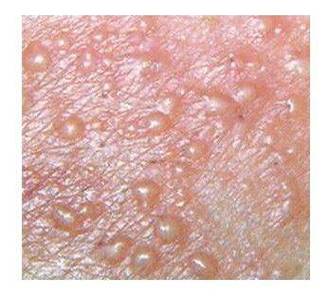 治疗生殖器疱疹