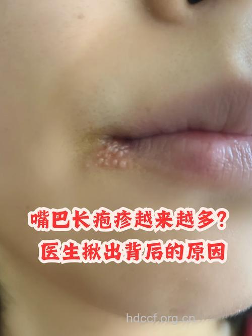 疾病百科 揭开单纯疱疹的面纱
