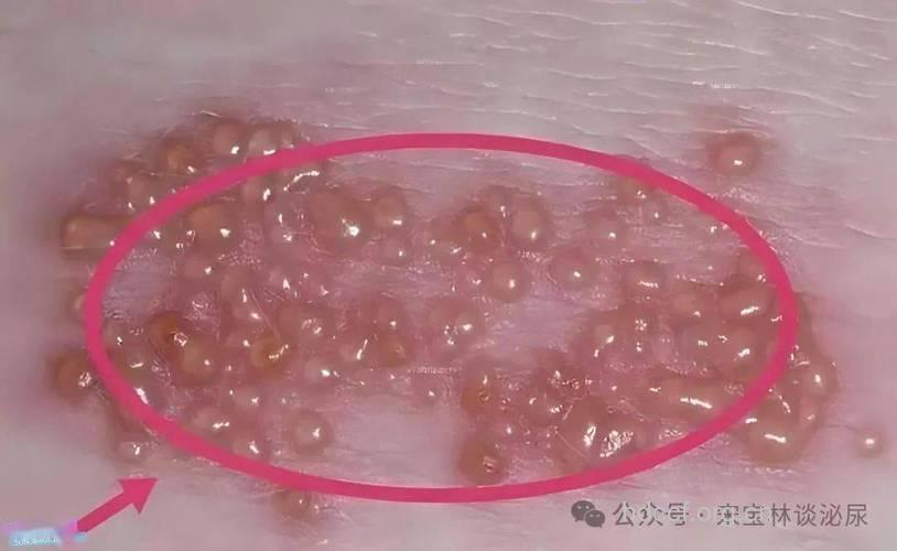 生殖器疱疹复发的特点