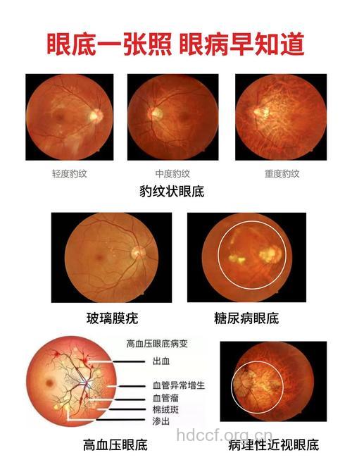 眼底病并非老年人专利