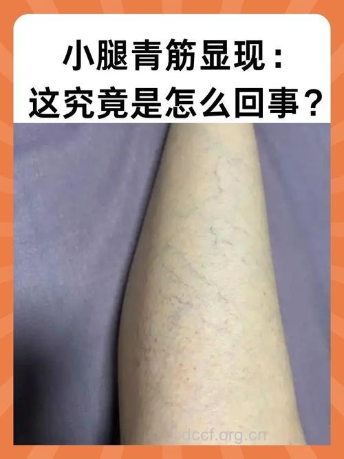 白领小腿发胀有青筋小心静脉曲张