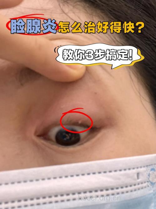 睑缘炎的症状有哪些?如何治疗?