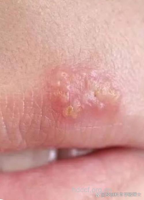 单纯疱疹的症状有哪些表现