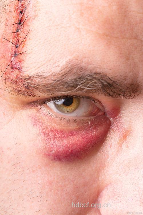 眼球钝挫伤者,需急送医院治疗