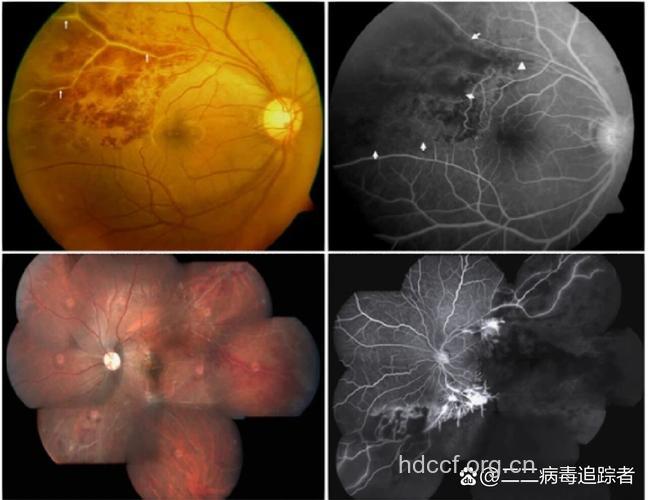 年轻男士慎防视网膜静脉周围炎