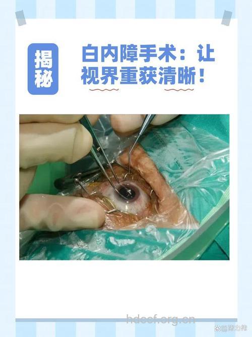 对付白内障的两大摘除术