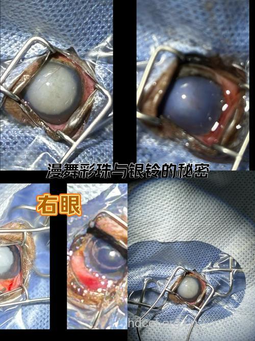 做完白内障手术后看不清如何是好?