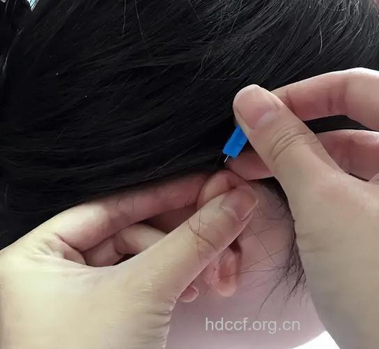 麦粒肿 可用中医放血疗法