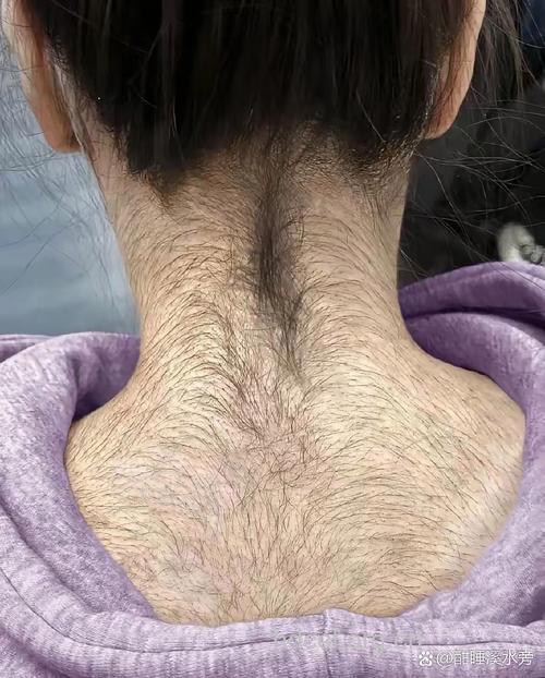 女性毛发旺盛并非是好事