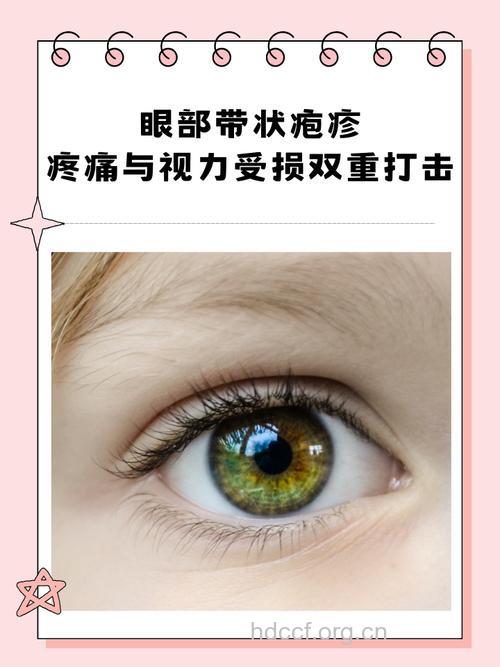 专家教你诊断眼睑带状疱疹