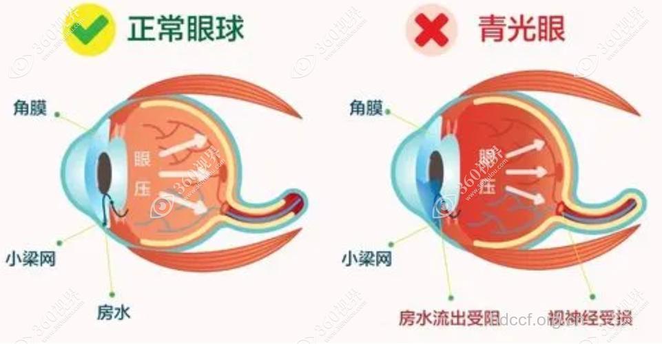 近视眼与青光眼的联系