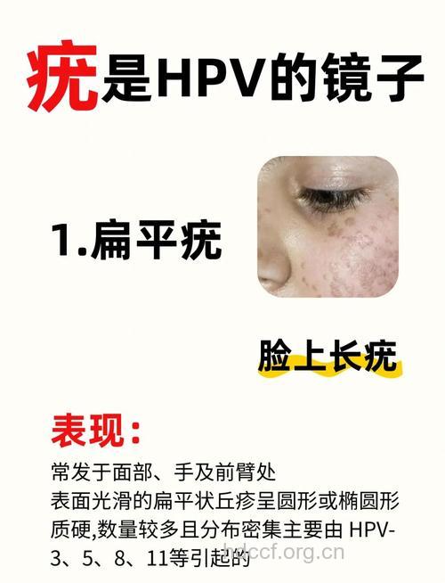 消灭病毒疣只要简单9招!