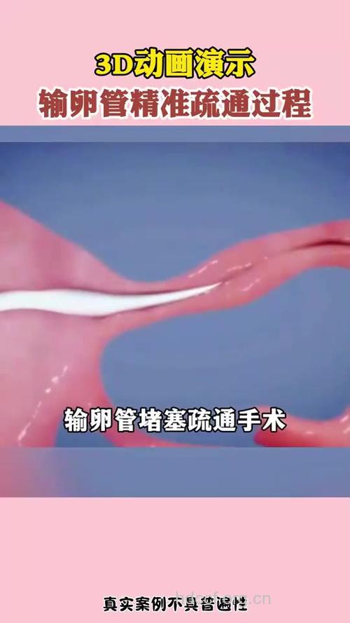 输卵管通液术是如何实施的?