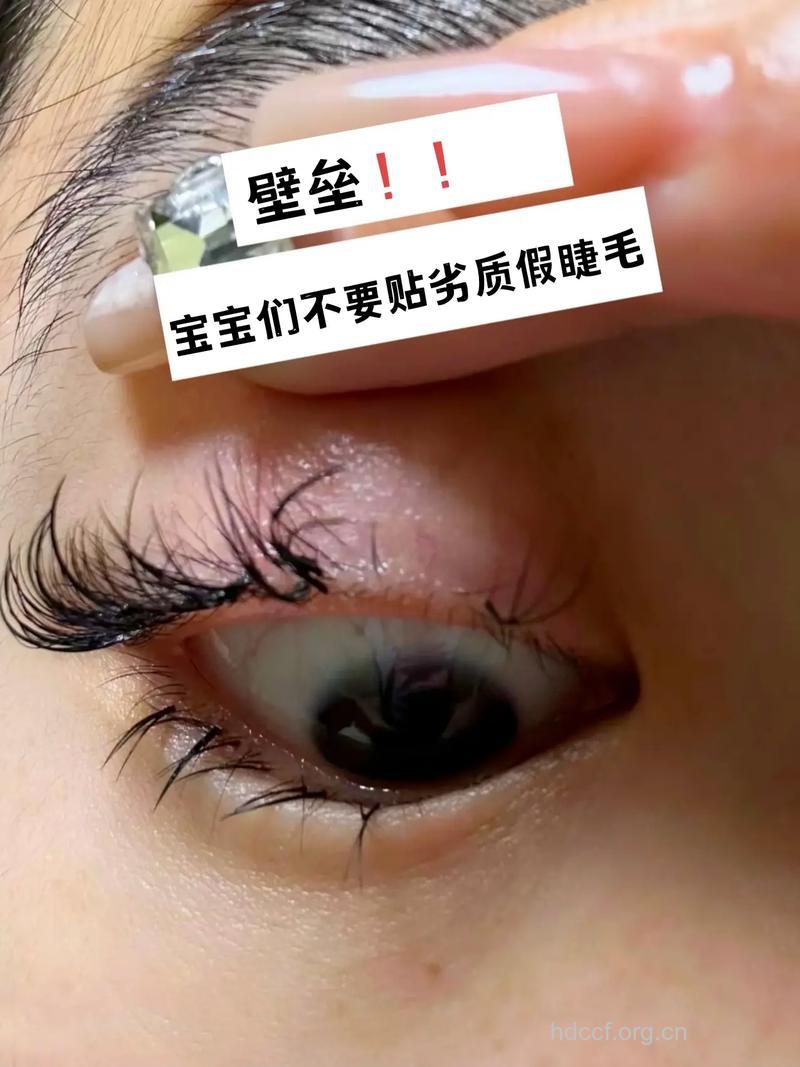 提防劣质假睫毛引发眼病