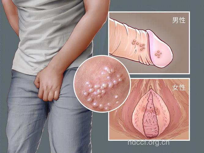 阴部长疱疹该做哪些检查?