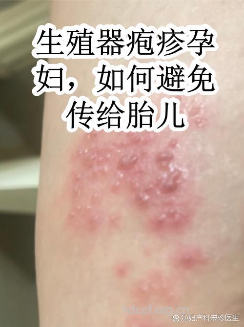 孕妇感染疱疹病毒将危及胎儿