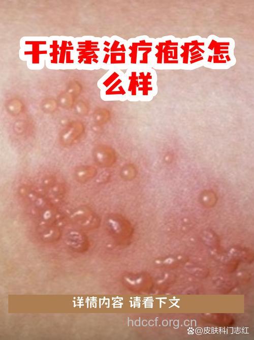 干扰素治疱疹的六大不良反应