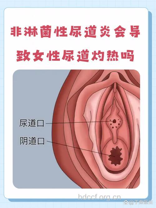 女性非淋菌性尿道炎症状体征