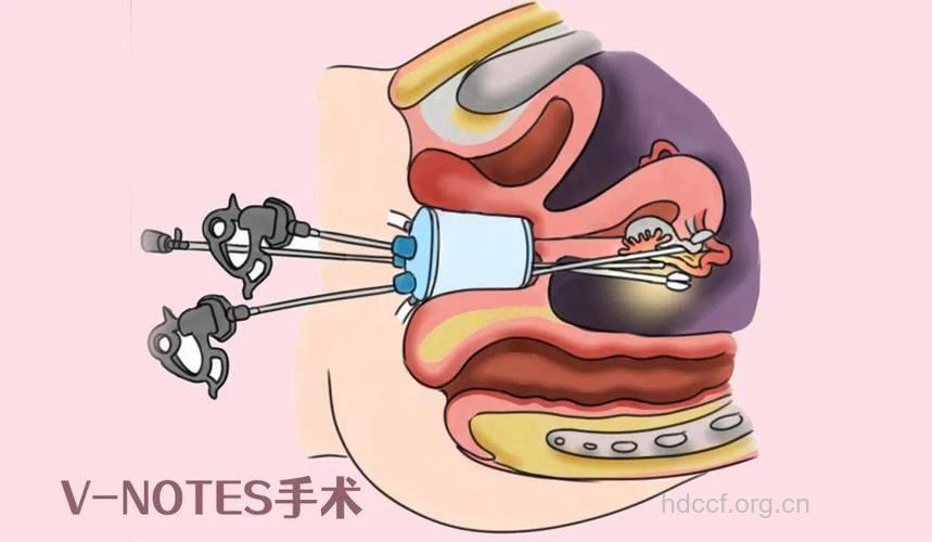 解读阴道后穹窿穿刺术