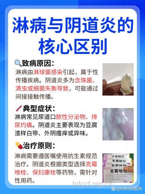 妇科炎症与非淋的关系