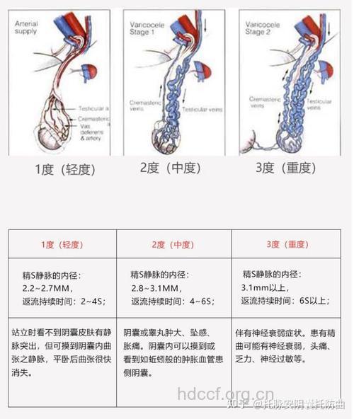 精索静脉曲张 男性不育原因之一