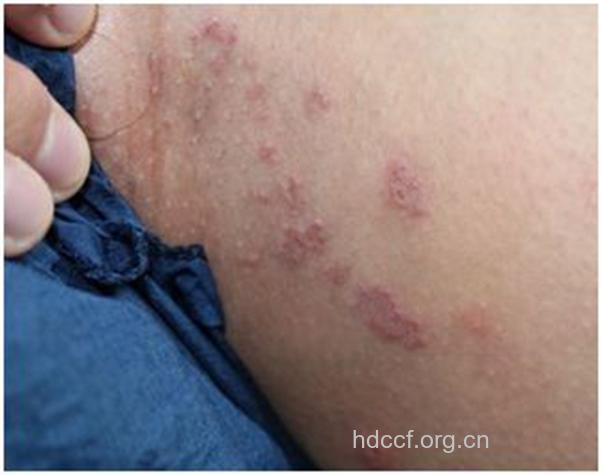 瘙痒皮疹青灰色斑 阴虱病的典型症状
