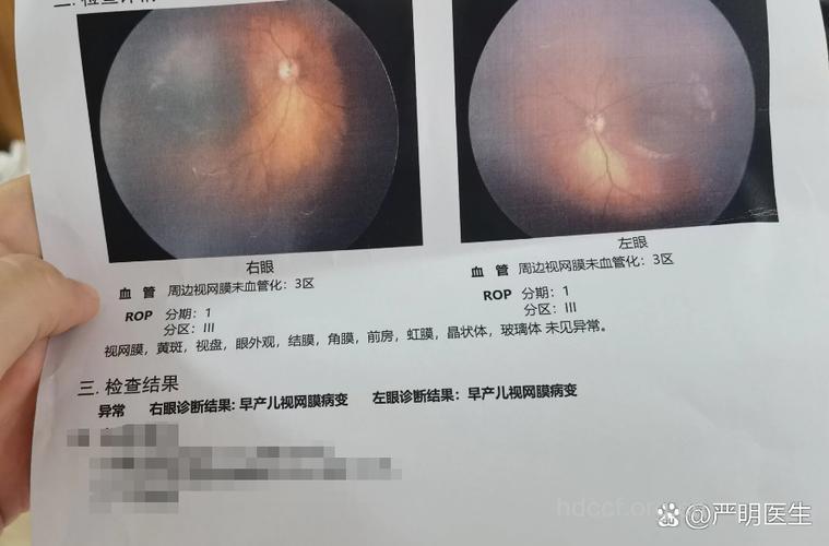 过度吸氧是早产儿视网膜病变的罪魁祸首