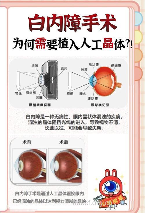 老年人白内障做人工晶体植入术注意事项