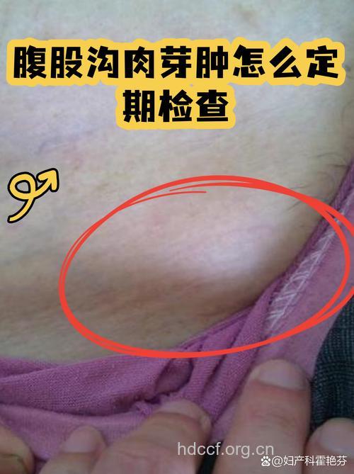 女性患腹股沟肉芽肿的3大症状