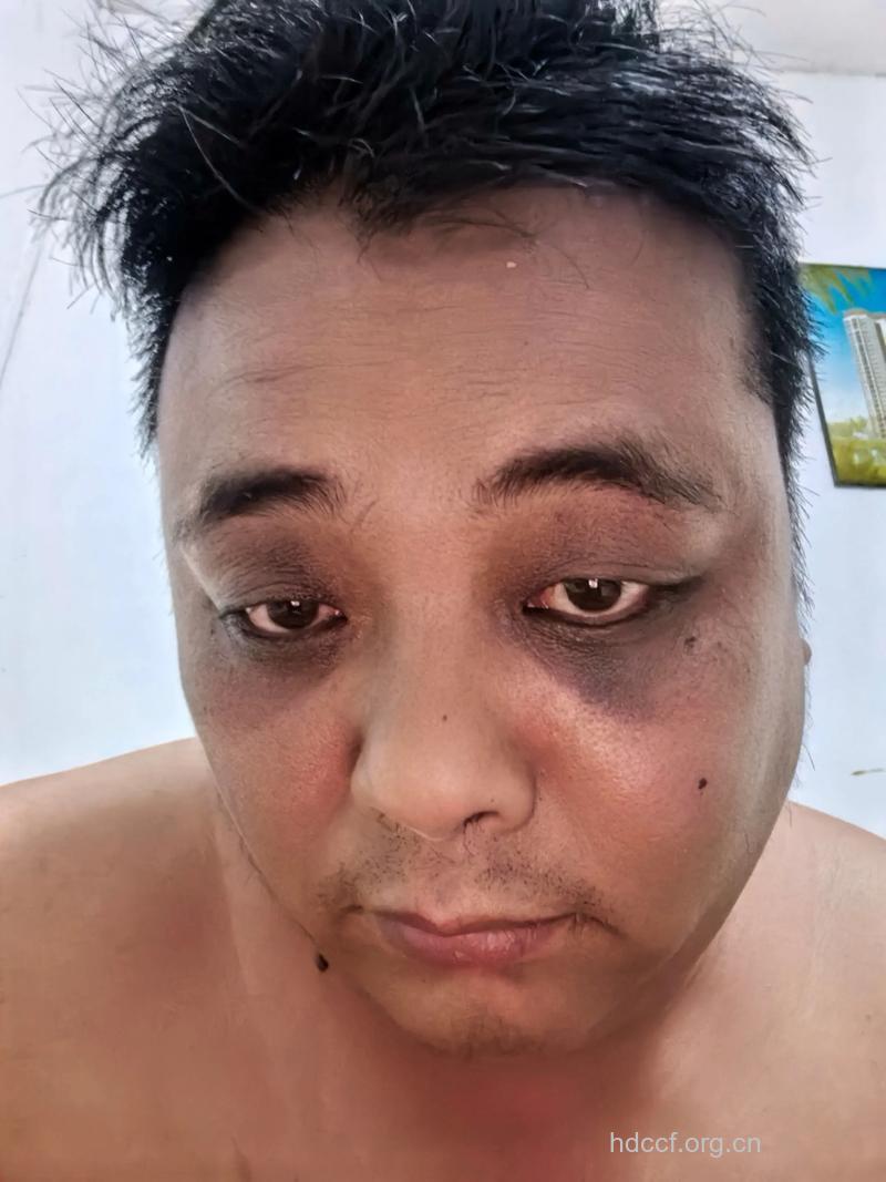 惊!男性经常熬夜易诱发怪眼病